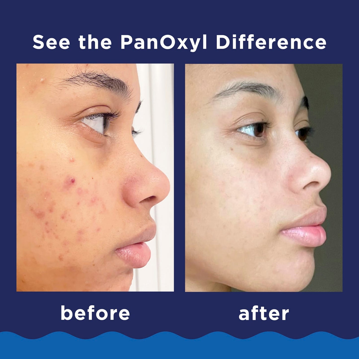 PanOxyl - Acne Foaming Wash with 10% Benzoyl Peroxide - 28g