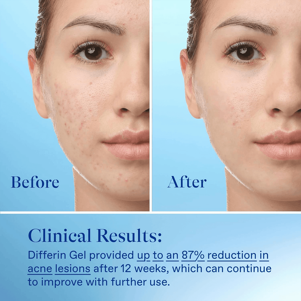 Differin Gel Adapalene Gel 0,1% Acne Treatment - Acne Zalf Tegen Acne & Verdere Uitbraak Van Acne - 15 gr